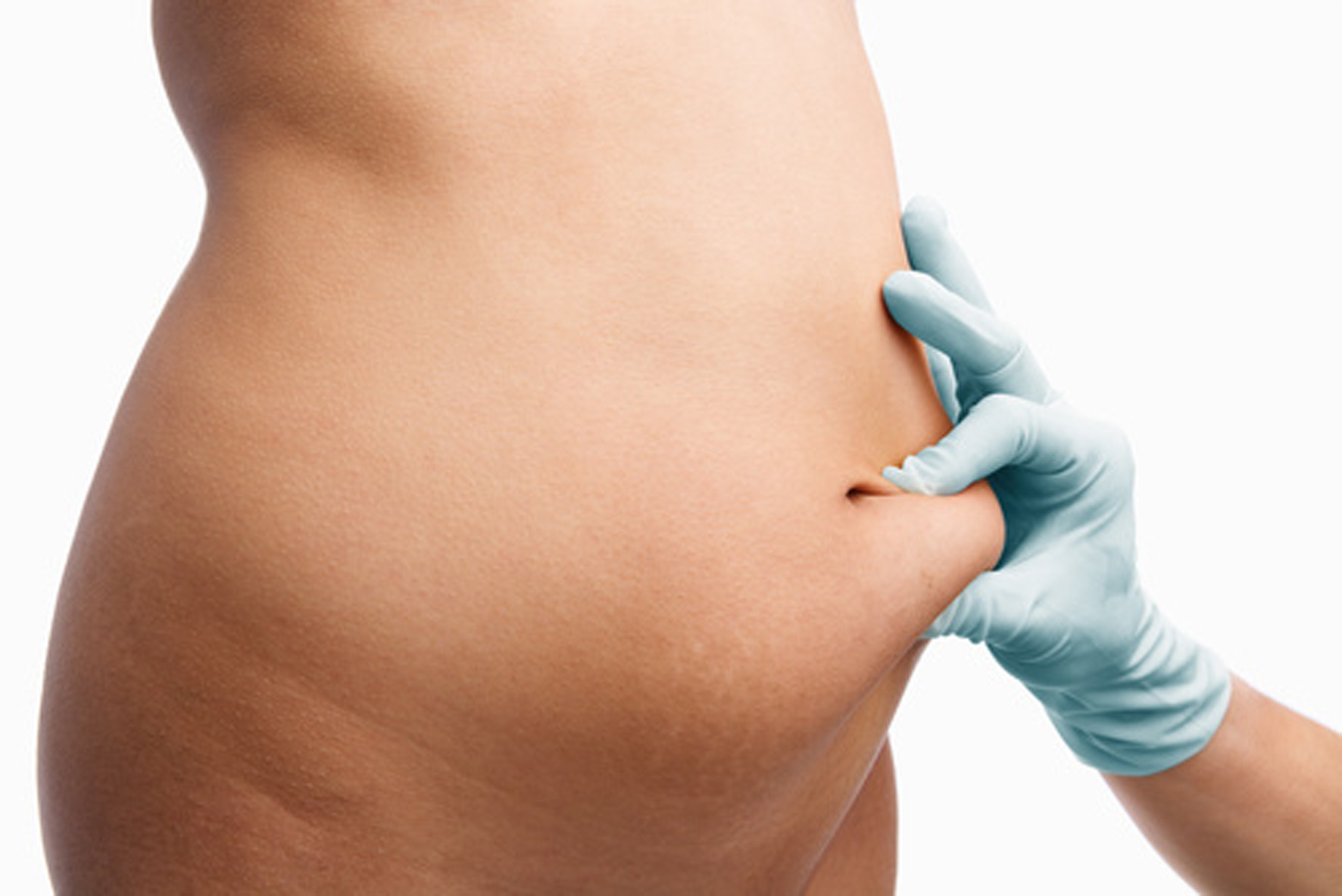 Tummy tuck! Your alliance after weight loss.